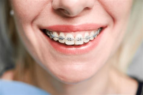 ortodoncia brackets metalicos precio|what are brackets in braces.